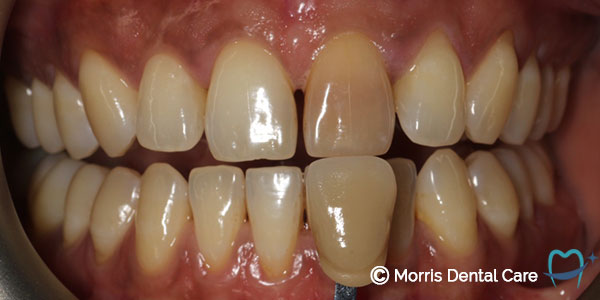 Image of a darkened front tooth that could be whitened to give the patiient a more confident smile.